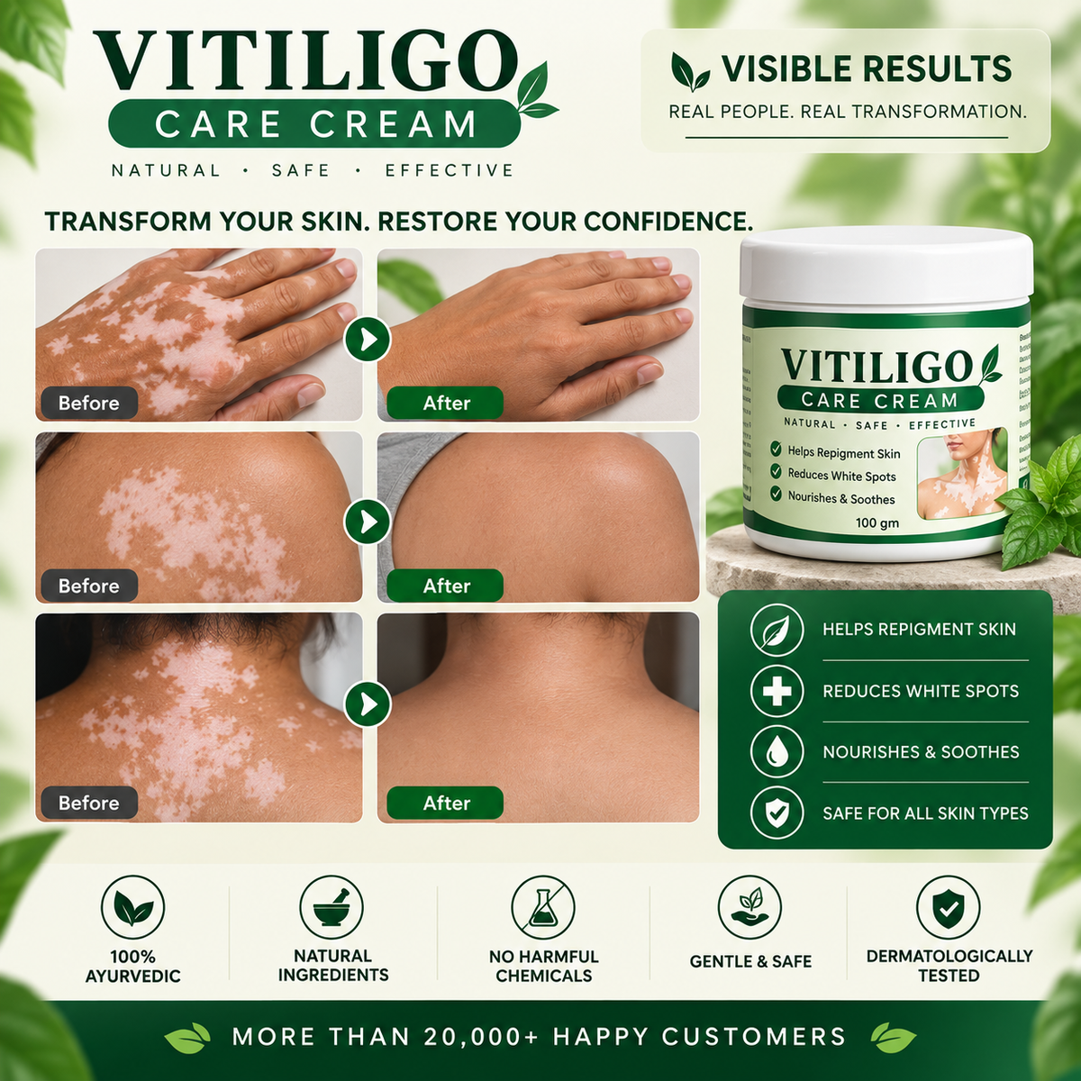 Vitiligo® Care Cream – Buy 1 Get 1 FREE